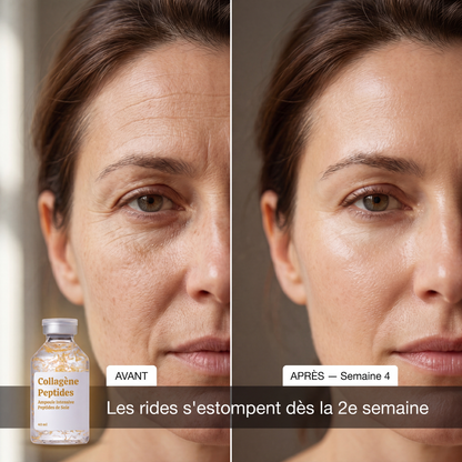 Lifting sans injection — porté par les fils de soie